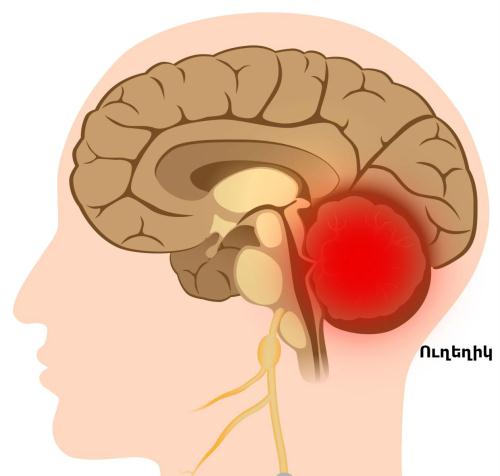 инфаркт мозжечка.jpg